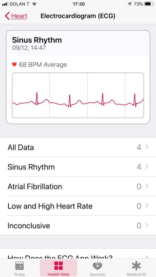 ECG Sinus Rhythm: 68 BPM Avg.