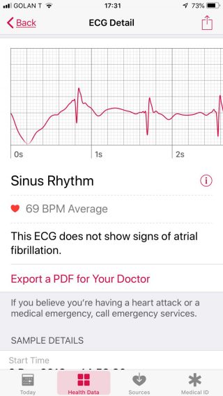 ECG Sinus Rhythm Detail